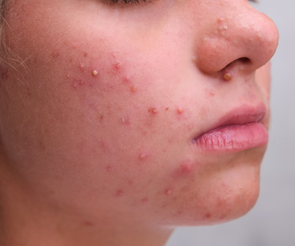 Representação visual de acne inflamatória na região facial.