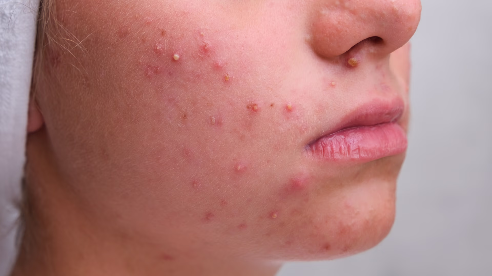 Close de rosto com acne inflamatória na bochecha e ao redor do nariz