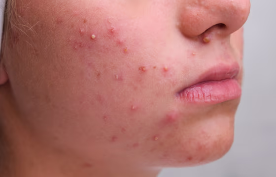 Close de rosto com acne inflamatória na bochecha e ao redor do nariz