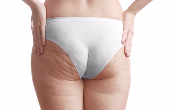 Mulher de costas com roupa clara, mostrando textura natural em glúteos e coxas associada à celulite