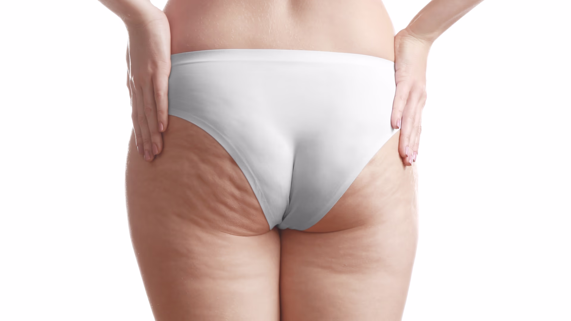 Mulher de costas com roupa clara, mostrando textura natural em glúteos e coxas associada à celulite