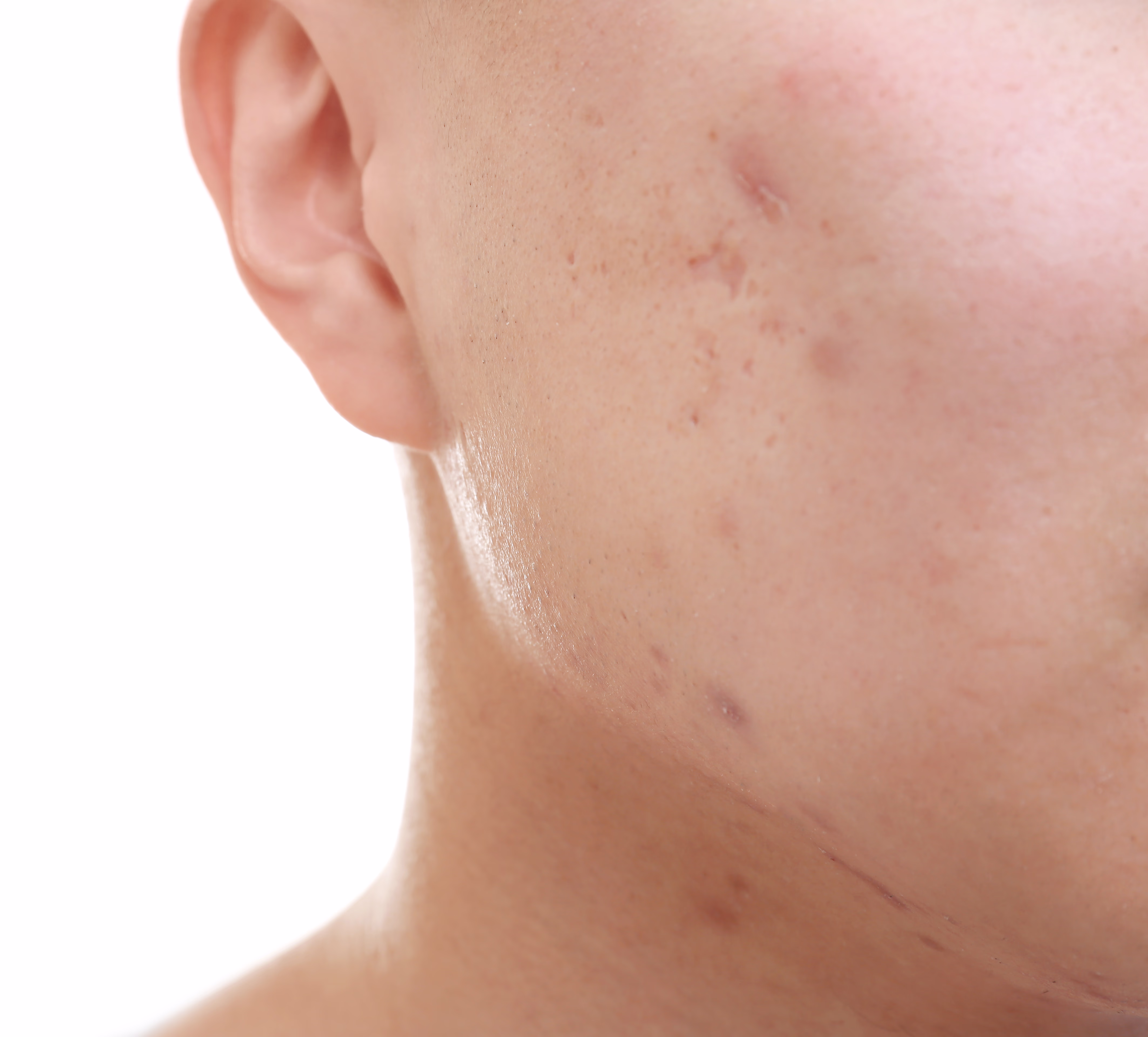 Tratamento para Cicatrizes de Acne