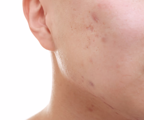 Representação visual de cicatrizes de acne e textura irregular da pele facial.