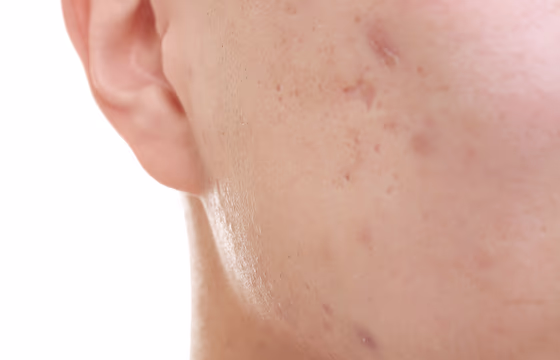 Close de bochecha com marcas pós-acne e irregularidades de textura