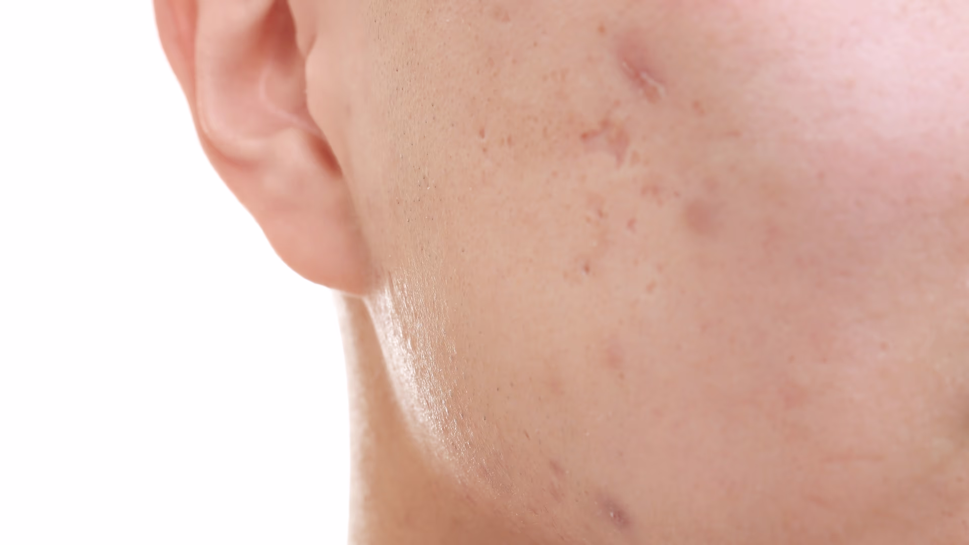 Close de bochecha com marcas pós-acne e irregularidades de textura