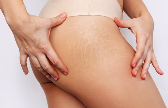 Close de pele corporal com estrias discretas, ilustrando tratamento para estrias