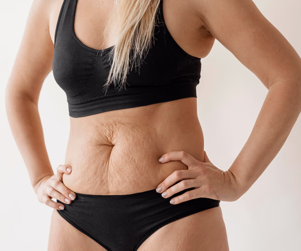Representação visual de flacidez abdominal com abordagem de cuidado e autoestima.