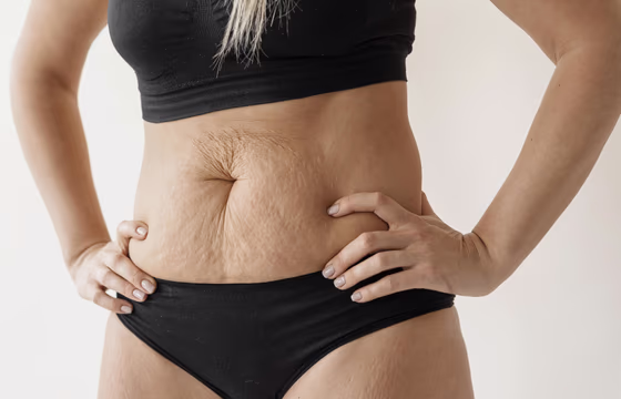 Mulher adulta em roupa íntima com foco na região abdominal, em imagem de tratamento para flacidez