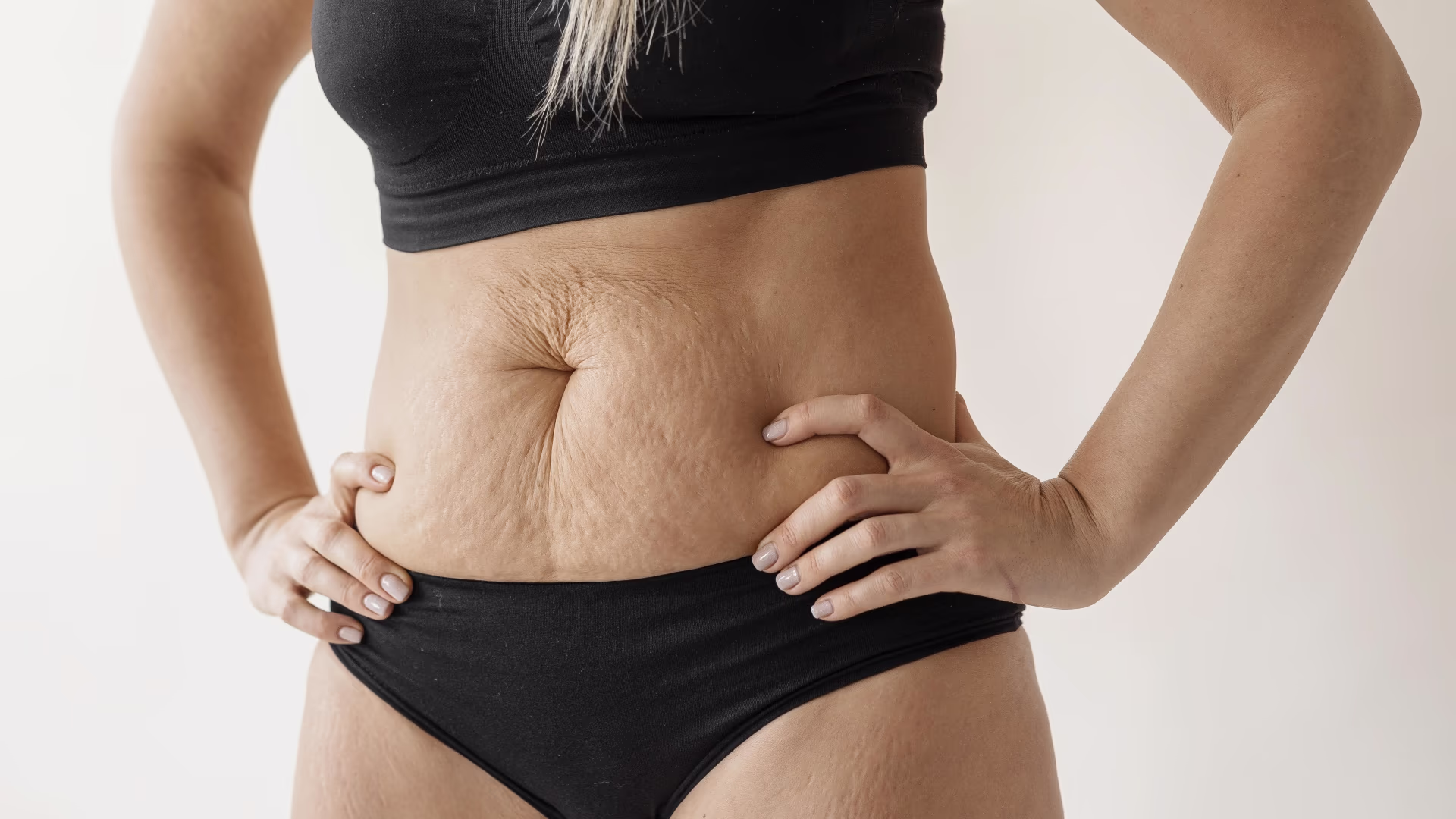 Mulher adulta em roupa íntima com foco na região abdominal, em imagem de tratamento para flacidez