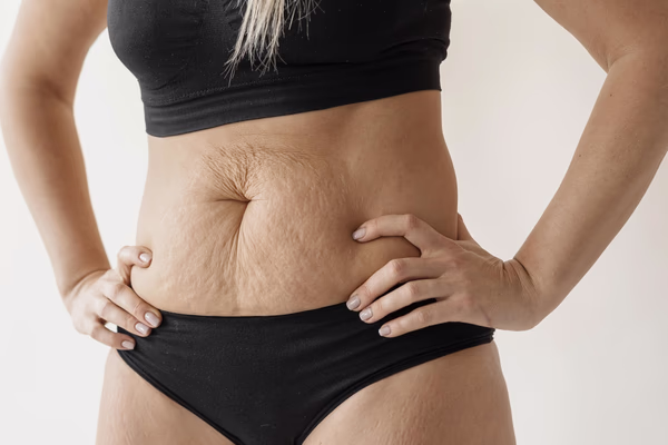 Mulher com roupa fitness mostrando flacidez abdominal leve, em imagem ilustrativa sobre mudanças corporais após emagrecimento