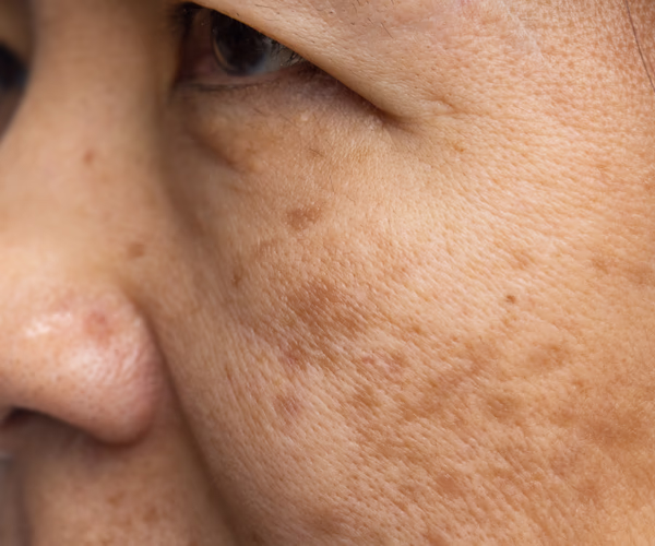 Representação visual de manchas e textura natural da pele facial.