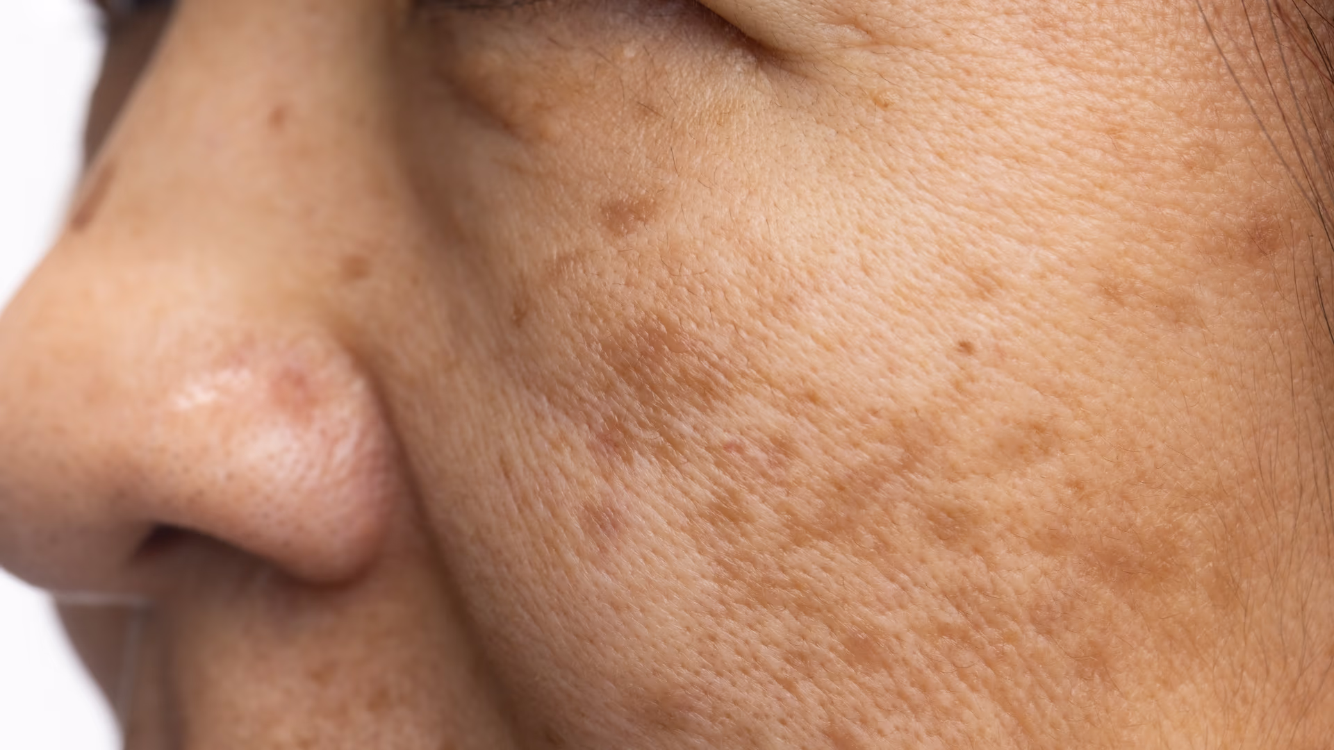 Close de bochecha com manchas e textura natural da pele facial