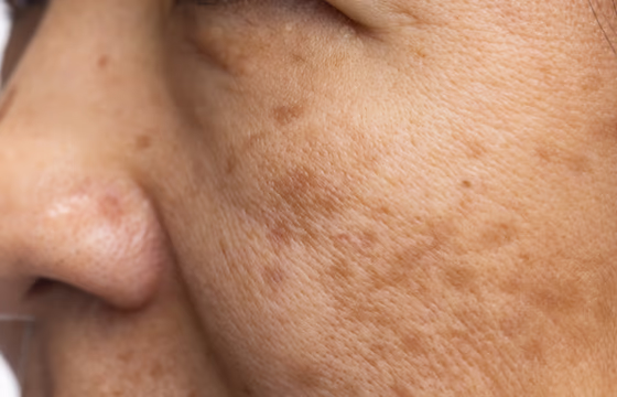 Close de bochecha com manchas e textura natural da pele facial