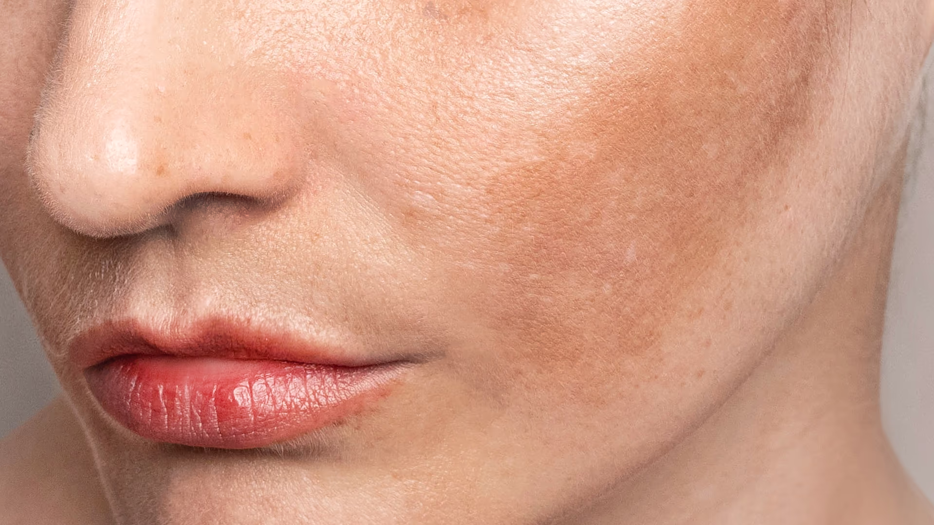 Close de pele facial com manchas acastanhadas compatíveis com melasma