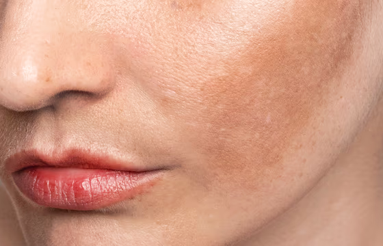 Close de pele facial com manchas acastanhadas compatíveis com melasma
