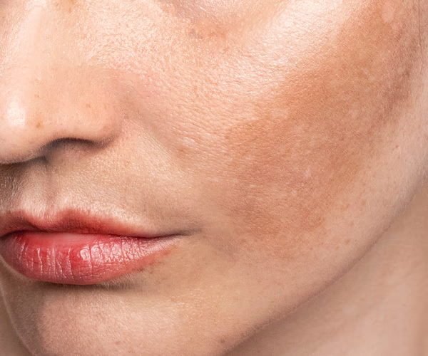 Representação visual de melasma facial com hiperpigmentação localizada.