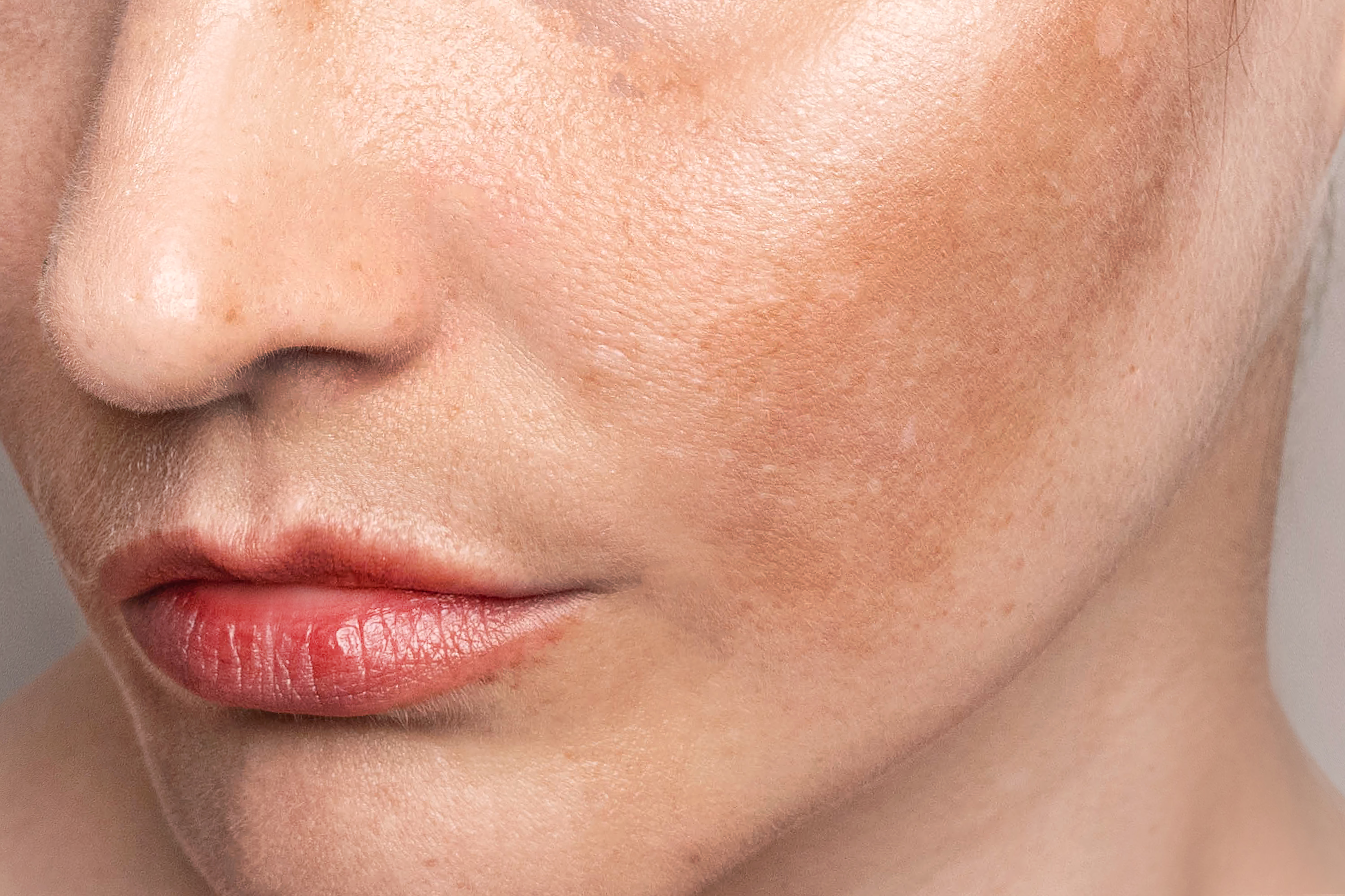 Tratamento para Melasma