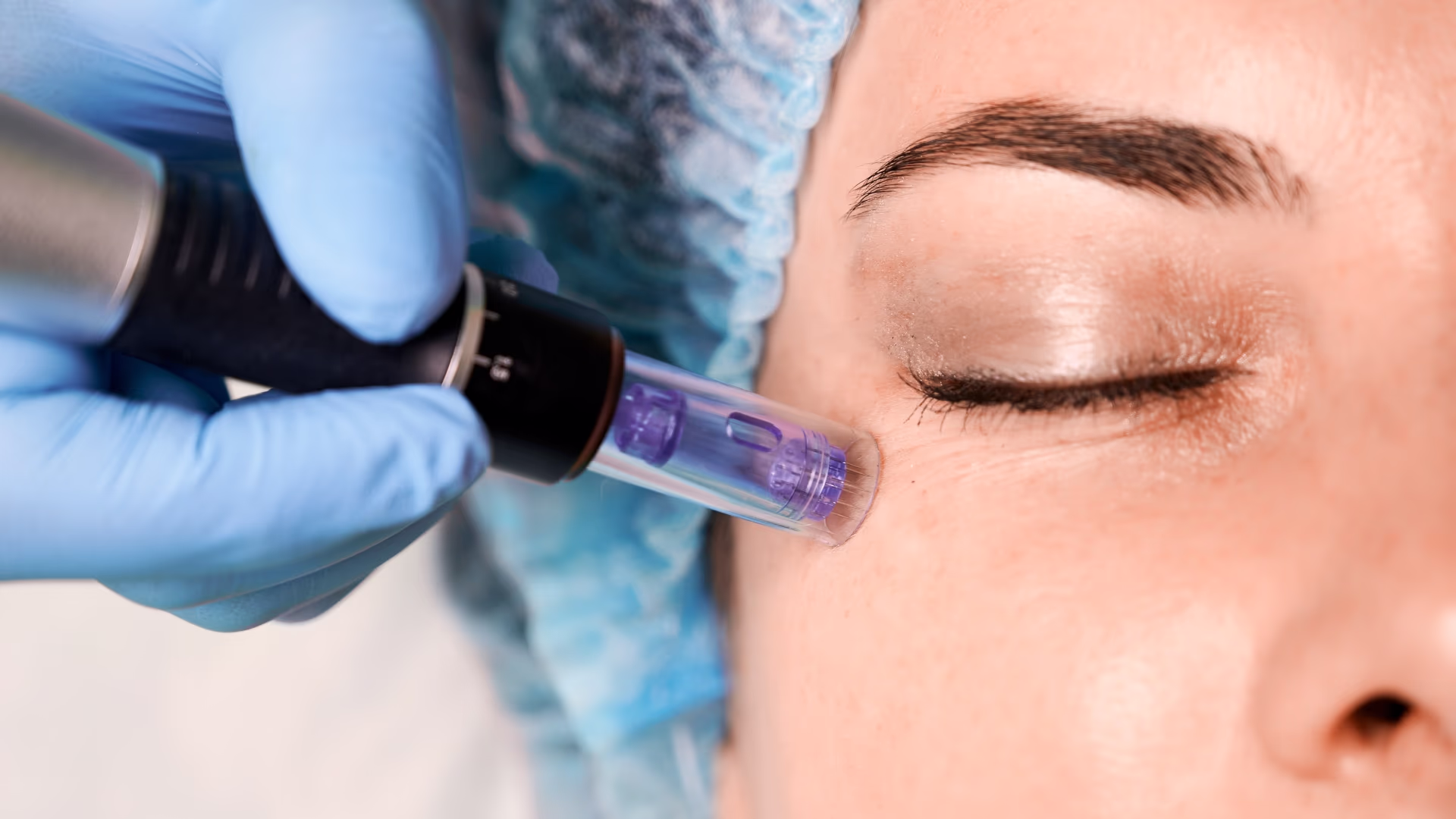 Profissional realizando microagulhamento facial com dermapen na região próxima aos olhos