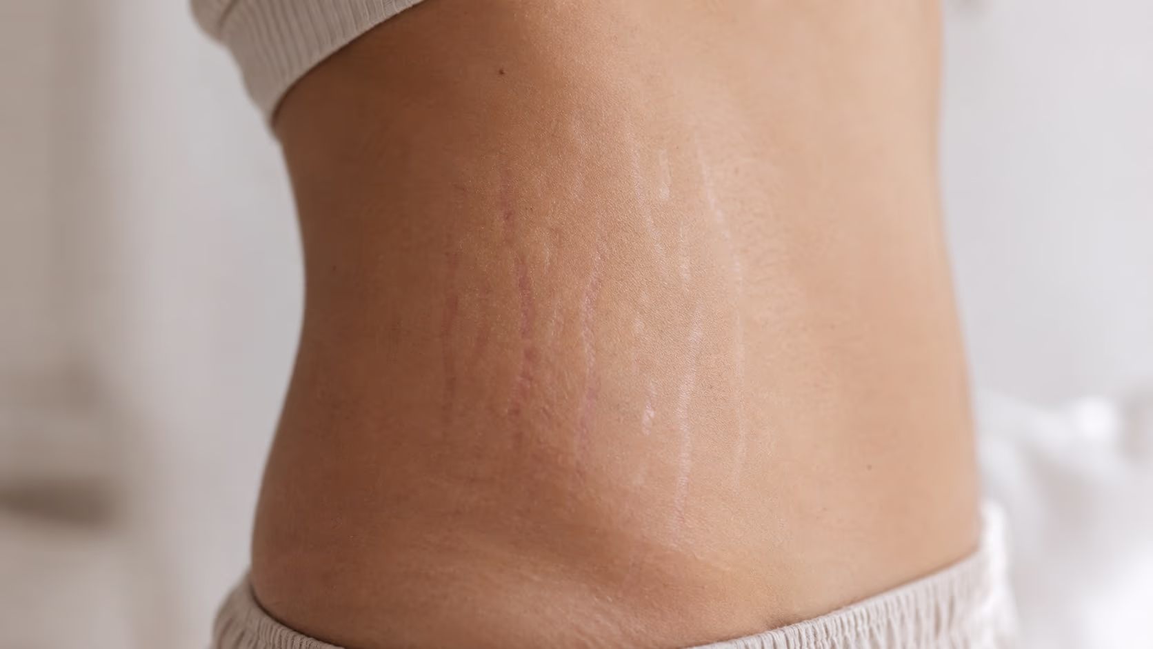 Close de abdômen com estrias discretas em iluminação suave, ilustrando diferenças entre estrias vermelhas e brancas