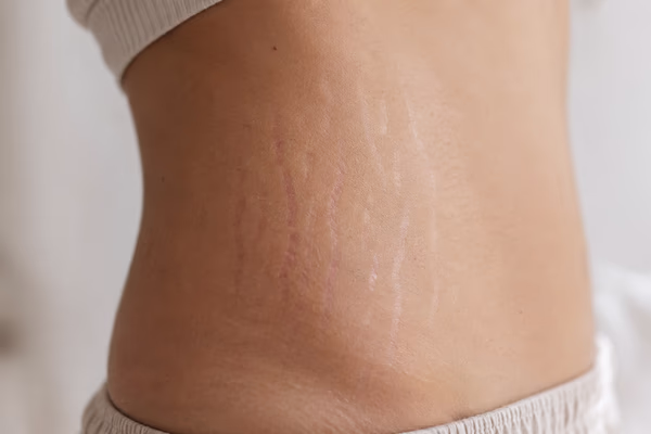 Close de abdômen com estrias discretas em iluminação suave, ilustrando diferenças entre estrias vermelhas e brancas